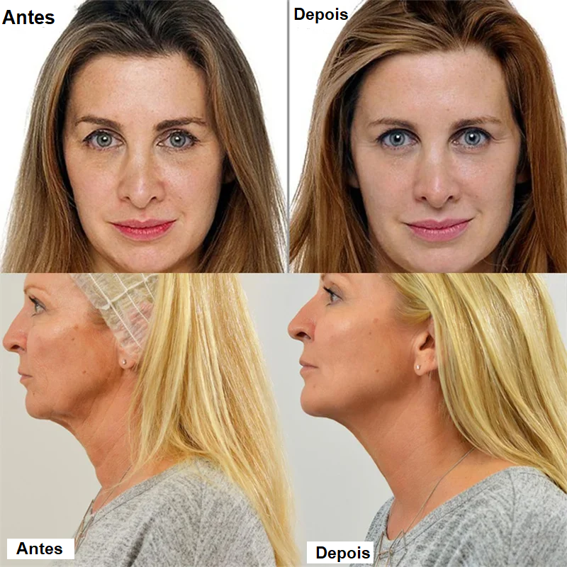 Conjunto de Fios  de Proteína de Colágeno Clean Face para Lifting Facial * Rugas-Reparação-Preenchimento * By Erazo